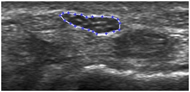 Figure 1: An exemplar US image of median nerve at the distal radius level that has been analyzed using our image analysis software.